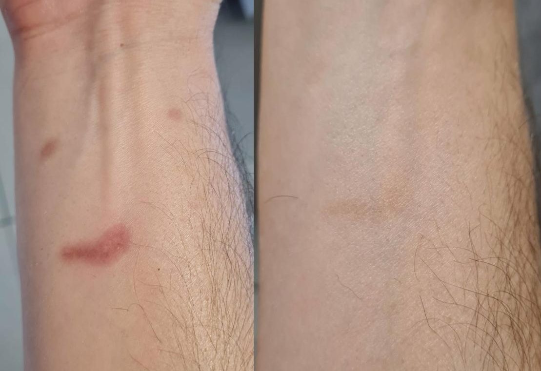 Burn scars before and after