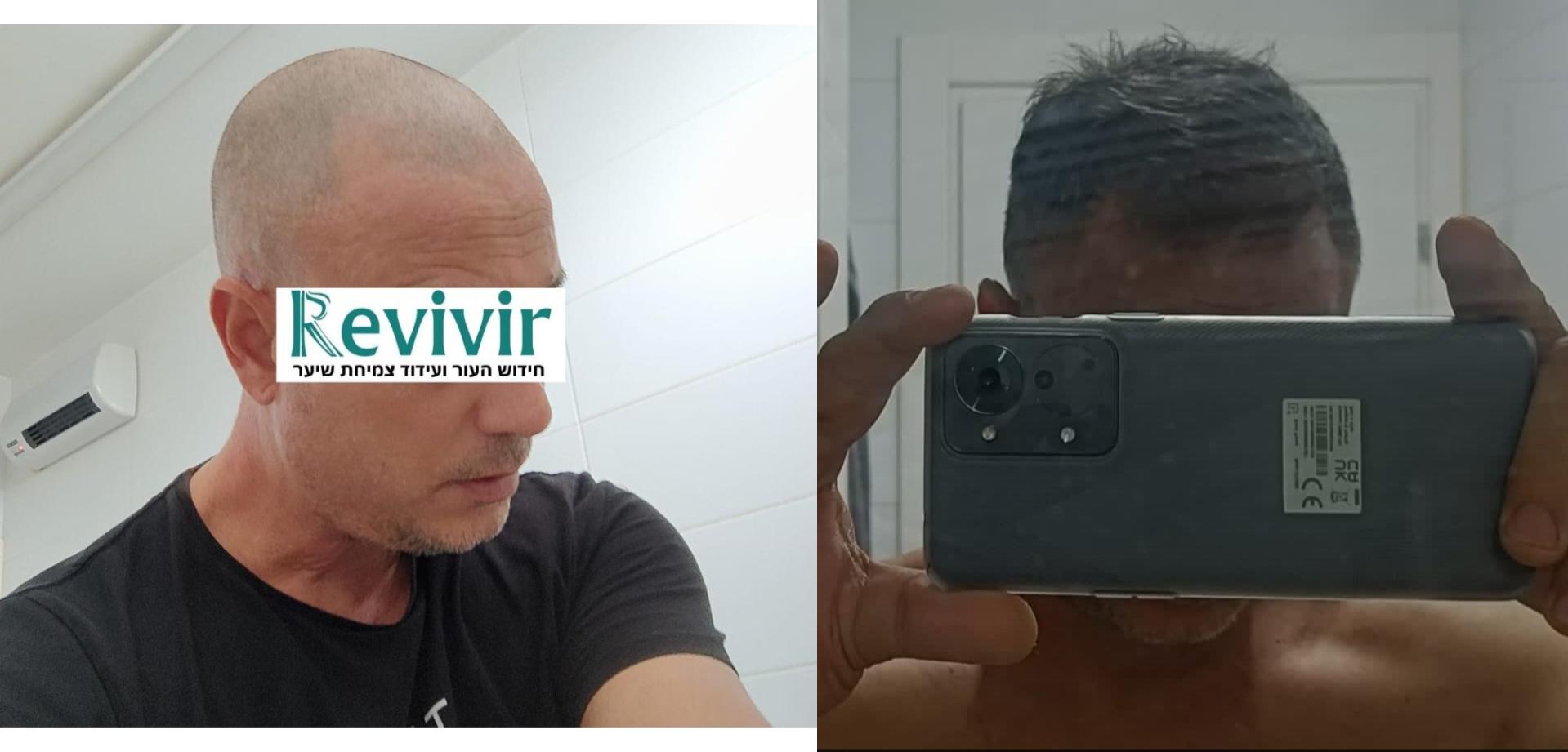 דרמה רולר לשיער - לפני ואחרי