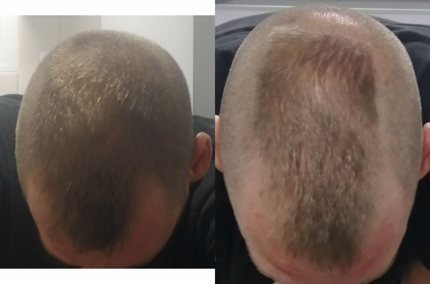 hair loss before and after 2